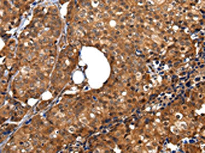 The image on the left is immunohistochemistry of paraffin-embedded Human breast cancer tissue using CSB-PA257697(ZBTB2 Antibody) at dilution 1/40, on the right is treated with synthetic peptide. (Original magnification: ×200)