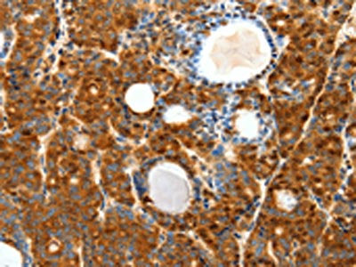 The image on the left is immunohistochemistry of paraffin-embedded Human thyroid cancer tissue using CSB-PA257758(SCTR Antibody) at dilution 1/40, on the right is treated with synthetic peptide. (Original magnification: ×200)