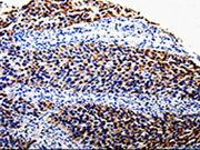 The image is immunohistochemistry of paraffin-embedded Human renal cancer tissue using CSB-PA257877(COX10 Antibody) at dilution 1/100. (Original magnification: 200)