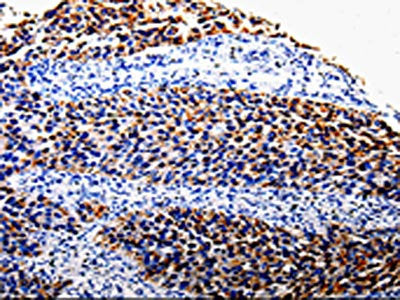 The image is immunohistochemistry of paraffin-embedded Human renal cancer tissue using CSB-PA257877(COX10 Antibody) at dilution 1/100. (Original magnification: 200)