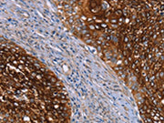The image on the left is immunohistochemistry of paraffin-embedded Human cervical cancer tissue using CSB-PA257925(CRH Antibody) at dilution 1/20, on the right is treated with synthetic peptide. (Original magnification: x200)