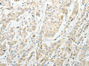 The image on the left is immunohistochemistry of paraffin-embedded Human breast cancer tissue using CSB-PA257995(AGBL1 Antibody) at dilution 1/15, on the right is treated with synthetic peptide. (Original magnification: ×200)
