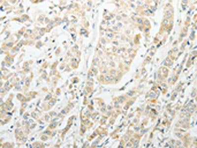 The image on the left is immunohistochemistry of paraffin-embedded Human breast cancer tissue using CSB-PA257995(AGBL1 Antibody) at dilution 1/15, on the right is treated with synthetic peptide. (Original magnification: ×200)