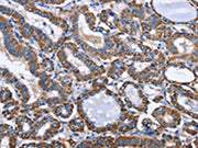 The image on the left is immunohistochemistry of paraffin-embedded Human thyroid cancer tissue using CSB-PA258120(INTS10 Antibody) at dilution 1/50, on the right is treated with fusion protein. (Original magnification: ×200)