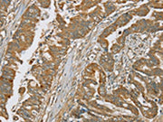 The image on the left is immunohistochemistry of paraffin-embedded Human esophagus cancer tissue using CSB-PA258225(SERPING1 Antibody) at dilution 1/20, on the right is treated with synthetic peptide. (Original magnification: ×200)