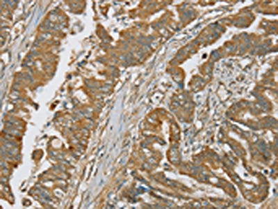 The image on the left is immunohistochemistry of paraffin-embedded Human esophagus cancer tissue using CSB-PA258225(SERPING1 Antibody) at dilution 1/20, on the right is treated with synthetic peptide. (Original magnification: ×200)