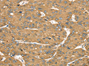 The image on the left is immunohistochemistry of paraffin-embedded Human liver cancer tissue using CSB-PA258249(SLIT1 Antibody) at dilution 1/35, on the right is treated with synthetic peptide. (Original magnification: ×200)