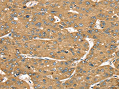 The image on the left is immunohistochemistry of paraffin-embedded Human liver cancer tissue using CSB-PA258249(SLIT1 Antibody) at dilution 1/35, on the right is treated with synthetic peptide. (Original magnification: ×200)