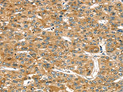 The image on the left is immunohistochemistry of paraffin-embedded Human liver cancer tissue using CSB-PA258476(RASSF9 Antibody) at dilution 1/45, on the right is treated with fusion protein. (Original magnification: ×200)
