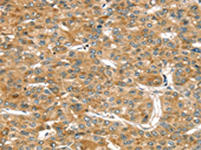 The image on the left is immunohistochemistry of paraffin-embedded Human liver cancer tissue using CSB-PA258476(RASSF9 Antibody) at dilution 1/45, on the right is treated with fusion protein. (Original magnification: ×200)