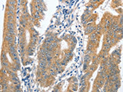 The image on the left is immunohistochemistry of paraffin-embedded Human colon cancer tissue using CSB-PA258870(CENPC Antibody) at dilution 1/70, on the right is treated with fusion protein. (Original magnification: ×200)