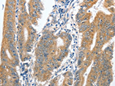 The image on the left is immunohistochemistry of paraffin-embedded Human colon cancer tissue using CSB-PA258870(CENPC Antibody) at dilution 1/70, on the right is treated with fusion protein. (Original magnification: ×200)