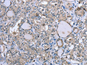 The image on the left is immunohistochemistry of paraffin-embedded Human thyroid cancer tissue using CSB-PA258899(FCAR Antibody) at dilution 1/20, on the right is treated with fusion protein. (Original magnification: ×200)