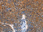 The image on the left is immunohistochemistry of paraffin-embedded Human liver cancer tissue using CSB-PA258902(AUP1 Antibody) at dilution 1/50, on the right is treated with fusion protein. (Original magnification: ×200)