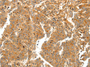 The image on the left is immunohistochemistry of paraffin-embedded Human liver cancer tissue using CSB-PA258944(SCT Antibody) at dilution 1/60, on the right is treated with synthetic peptide. (Original magnification: ×200)