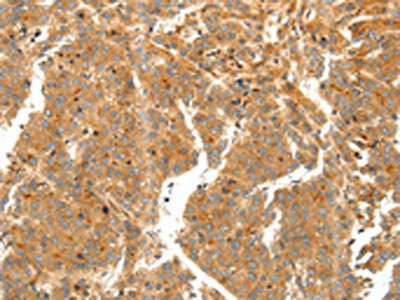 The image on the left is immunohistochemistry of paraffin-embedded Human liver cancer tissue using CSB-PA258944(SCT Antibody) at dilution 1/60, on the right is treated with synthetic peptide. (Original magnification: ×200)