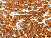 The image on the left is immunohistochemistry of paraffin-embedded Human liver cancer tissue using CSB-PA258964(PLXNA3 Antibody) at dilution 1/25, on the right is treated with synthetic peptide. (Original magnification: ×200)