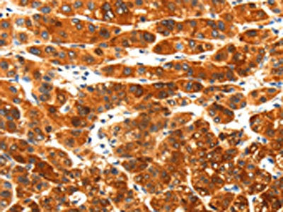 The image on the left is immunohistochemistry of paraffin-embedded Human liver cancer tissue using CSB-PA258964(PLXNA3 Antibody) at dilution 1/25, on the right is treated with synthetic peptide. (Original magnification: ×200)