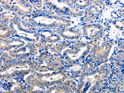 The image is immunohistochemistry of paraffin-embedded Human thyroid cancer tissue using CSB-PA259078(NFKB1 Antibody) at dilution 1/5. (Original magnification: 200)