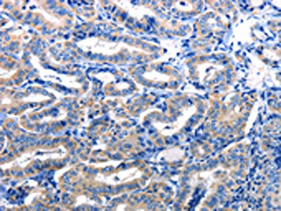 The image is immunohistochemistry of paraffin-embedded Human thyroid cancer tissue using CSB-PA259078(NFKB1 Antibody) at dilution 1/5. (Original magnification: 200)