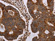 The image on the left is immunohistochemistry of paraffin-embedded Human colon cancer tissue using CSB-PA259300(MAGEC2 Antibody) at dilution 1/40, on the right is treated with synthetic peptide. (Original magnification: ×200)