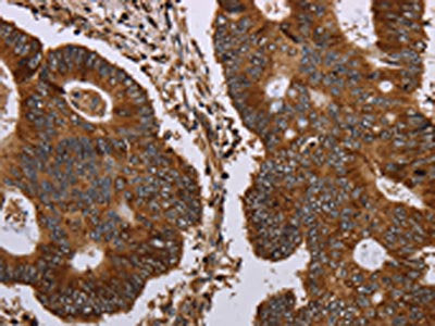 The image on the left is immunohistochemistry of paraffin-embedded Human colon cancer tissue using CSB-PA259300(MAGEC2 Antibody) at dilution 1/40, on the right is treated with synthetic peptide. (Original magnification: ×200)
