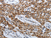 The image on the left is immunohistochemistry of paraffin-embedded Human lung cancer tissue using CSB-PA259311(SPAG1 Antibody) at dilution 1/25, on the right is treated with synthetic peptide. (Original magnification: ×200)