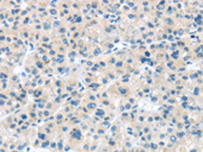 The image on the left is immunohistochemistry of paraffin-embedded Human liver cancer tissue using CSB-PA259468(CD63 Antibody) at dilution 1/25, on the right is treated with synthetic peptide. (Original magnification: ×200)