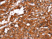 The image on the left is immunohistochemistry of paraffin-embedded Human thyroid cancer tissue using CSB-PA259482(FEM1A Antibody) at dilution 1/20, on the right is treated with synthetic peptide. (Original magnification: ×200)