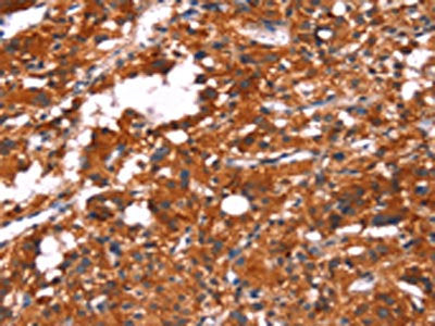 The image on the left is immunohistochemistry of paraffin-embedded Human thyroid cancer tissue using CSB-PA259482(FEM1A Antibody) at dilution 1/20, on the right is treated with synthetic peptide. (Original magnification: ×200)