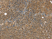 The image on the left is immunohistochemistry of paraffin-embedded Human ovarian cancer tissue using CSB-PA259630(MED12 Antibody) at dilution 1/30, on the right is treated with synthetic peptide. (Original magnification: ×200)