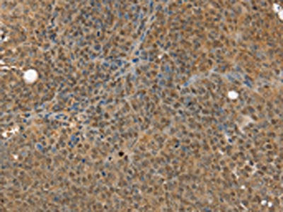 The image on the left is immunohistochemistry of paraffin-embedded Human ovarian cancer tissue using CSB-PA259630(MED12 Antibody) at dilution 1/30, on the right is treated with synthetic peptide. (Original magnification: ×200)