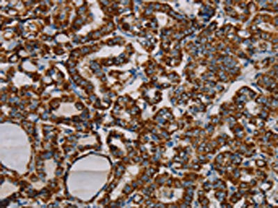 The image on the left is immunohistochemistry of paraffin-embedded Human thyroid cancer tissue using CSB-PA259631(MRPL12 Antibody) at dilution 1/20, on the right is treated with fusion protein. (Original magnification: ×200)