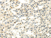 The image on the left is immunohistochemistry of paraffin-embedded Human breast cancer tissue using CSB-PA259822(CDKN1A Antibody) at dilution 1/30, on the right is treated with fusion protein. (Original magnification: ×200)