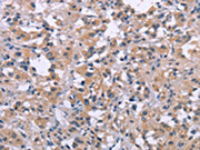 The image on the left is immunohistochemistry of paraffin-embedded Human thyroid cancer tissue using CSB-PA259888(DUSP1 Antibody) at dilution 1/30, on the right is treated with synthetic peptide. (Original magnification: X200)
