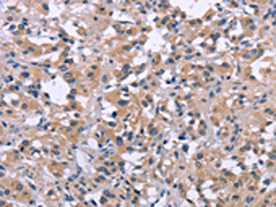 The image on the left is immunohistochemistry of paraffin-embedded Human thyroid cancer tissue using CSB-PA259888(DUSP1 Antibody) at dilution 1/30, on the right is treated with synthetic peptide. (Original magnification: X200)