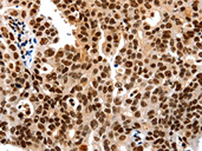 The image on the left is immunohistochemistry of paraffin-embedded Human ovarian cancer tissue using CSB-PA260045(HDAC2 Antibody) at dilution 1/25, on the right is treated with synthetic peptide. (Original magnification: ×200)