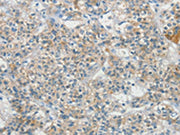 The image on the left is immunohistochemistry of paraffin-embedded Human liver cancer tissue using CSB-PA260136(SCN9A Antibody) at dilution 1/20, on the right is treated with synthetic peptide. (Original magnification: ×200)