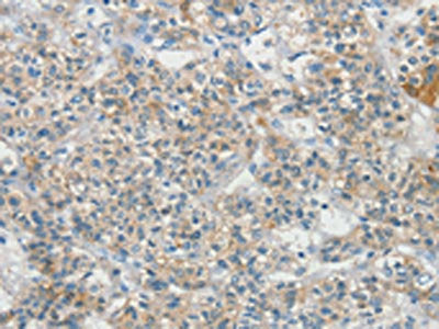 The image on the left is immunohistochemistry of paraffin-embedded Human liver cancer tissue using CSB-PA260136(SCN9A Antibody) at dilution 1/20, on the right is treated with synthetic peptide. (Original magnification: ×200)