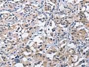 The image on the left is immunohistochemistry of paraffin-embedded Human thyroid cancer tissue using CSB-PA260295(CEACAM3 Antibody) at dilution 1/60, on the right is treated with fusion protein. (Original magnification: ×200)