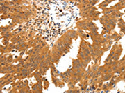 The image on the left is immunohistochemistry of paraffin-embedded Human ovarian cancer tissue using CSB-PA260413(SSTR2 Antibody) at dilution 1/30, on the right is treated with synthetic peptide. (Original magnification: ×200)