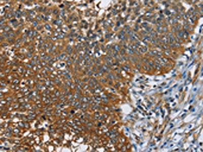 The image on the left is immunohistochemistry of paraffin-embedded Human cervical cancer tissue using CSB-PA260515(CAST Antibody) at dilution 1/60, on the right is treated with fusion protein. (Original magnification: ×200)