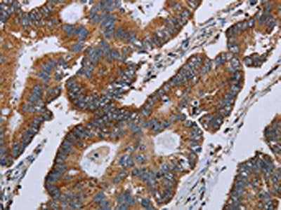 The image on the left is immunohistochemistry of paraffin-embedded Human colon cancer tissue using CSB-PA260526(MT-ND3 Antibody) at dilution 1/20, on the right is treated with synthetic peptide. (Original magnification: ×200)