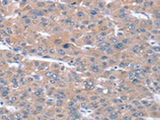 The image on the left is immunohistochemistry of paraffin-embedded Human liver cancer tissue using CSB-PA260604(SULF1 Antibody) at dilution 1/20, on the right is treated with synthetic peptide. (Original magnification: ×200)