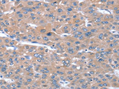 The image on the left is immunohistochemistry of paraffin-embedded Human liver cancer tissue using CSB-PA260604(SULF1 Antibody) at dilution 1/20, on the right is treated with synthetic peptide. (Original magnification: ×200)