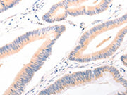 The image on the left is immunohistochemistry of paraffin-embedded Human colon cancer tissue using CSB-PA260955(ACR Antibody) at dilution 1/20, on the right is treated with synthetic peptide. (Original magnification: ×200)