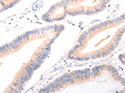 The image on the left is immunohistochemistry of paraffin-embedded Human colon cancer tissue using CSB-PA260955(ACR Antibody) at dilution 1/20, on the right is treated with synthetic peptide. (Original magnification: ×200)