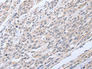 The image on the left is immunohistochemistry of paraffin-embedded Human esophagus cancer tissue using CSB-PA261024(TNK2 Antibody) at dilution 1/20, on the right is treated with fusion protein. (Original magnification: ×200)