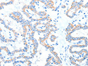The image on the left is immunohistochemistry of paraffin-embedded Human thyroid cancer tissue using CSB-PA261035(ADAM17 Antibody) at dilution 1/15, on the right is treated with fusion protein. (Original magnification: ×200)