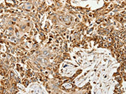 The image on the left is immunohistochemistry of paraffin-embedded Human esophagus cancer tissue using CSB-PA261251(SLC9A7 Antibody) at dilution 1/60, on the right is treated with synthetic peptide. (Original magnification: ×200)